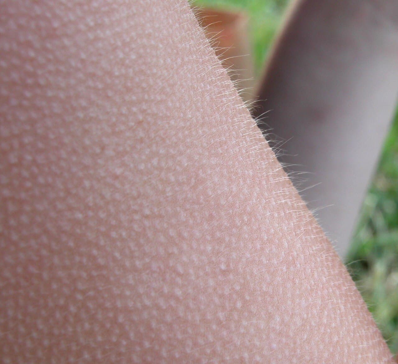Close-up of a forearm covered in goose bumps, with tiny raised bumps at the base of each hair.